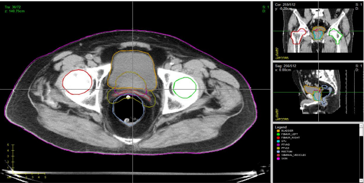 DEVELOPING NUMERICAL METHODS AND SIMULATIONS FOR TRAININGS IN RADIOTHERAPY