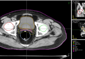 DEVELOPING NUMERICAL METHODS AND SIMULATIONS FOR TRAININGS IN RADIOTHERAPY